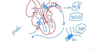 Patent Ductus Arteriousus [upl. by Teillo]