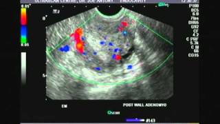 adenomyosissagittal1ampg [upl. by Saum]