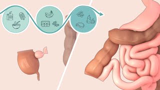 Ileocolic resection for Crohns disease  Patient Education  TVASurg [upl. by Hamal927]