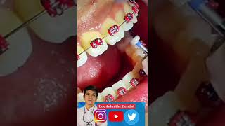 ENAMELOPLASTY Lagaring Ngipin paano inaayos [upl. by Nylrac253]