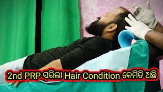 Finally 2nd PRP ସରିଗଲା କଣ ସତରେ Hair Regrowth ହବ hairtransplant odiavlog [upl. by Adyela409]