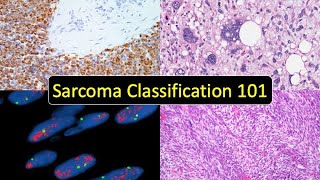 Sarcoma Classification 101 Soft Tissue Tumor Naming Made Simple for Beginners amp NonPathologists [upl. by Ashjian]