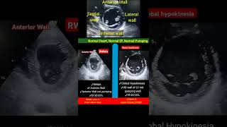 RWMA vs Global hypokinesia Echo l shorts echo dcmp [upl. by Haimehen]