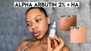 The Ordinarys Alpha Arbutin 2  HA Review  Fade Dark Spots Fast [upl. by Nevah]