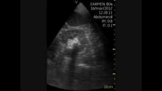 Litiasis Renal Ecografia y urgencias [upl. by Robbin]