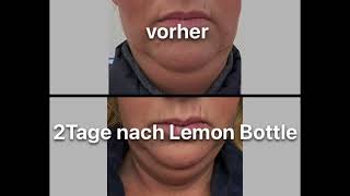 🍋LEMON BOTTLE  Doppelkinn bei LIFTNESS The Beauty Expert in Essen [upl. by Plerre]