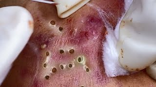 Big Cystic Acne Blackheads Extraction Blackheads amp Milia Whiteheads Removal Pimple Popping 086 [upl. by Apgar]