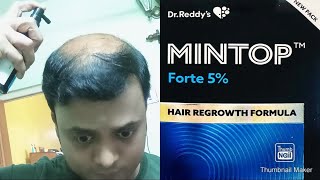 Mintop Forte 5 Minoxidil II Hair Regrowth Formula II Baldness cure II procapil amp Cococin [upl. by Aisatsanna]