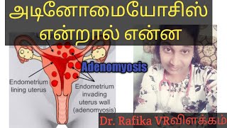 அடினோமையோசிஸ் என்றால் என்ன  what is adenomyosis Bd treatment and symptoms in tamil [upl. by Evelinn]