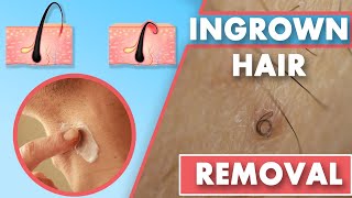 How to get rid of ingrown hairs on legs and thighs at home [upl. by Clintock83]