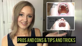 Palate Expander As An Adult Pros and Cons amp Tips and Tricks BEFORE AND AFTER [upl. by Selene]