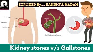 causes and symptoms about kidney stones vs Gallstones and remedies with IMC products [upl. by Demmahom]