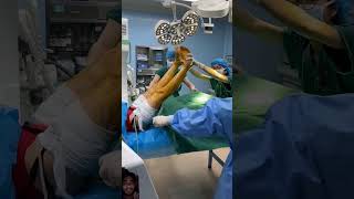 Operation theatre lithotomy positionMBBS surgery sohorts shortsyoutube operationpolo [upl. by Marolda455]