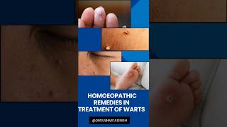 Warts treatment [upl. by Kaenel]