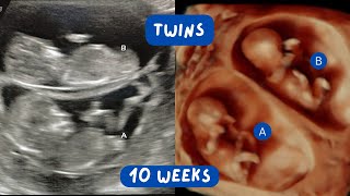 Cute Ultrasound Video of Twins at 11 Weeks Gestation  Scan of the Week [upl. by Mariellen]