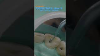 Essentials in endodontics ULTRA X eighteeth [upl. by Rep661]