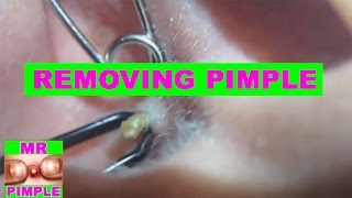 Removing Pimple Inside The Ear  Mr Pimple [upl. by Dine163]