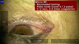 Punctal occlusion using MicroRF in Aqueous Deficiency Dry Eye [upl. by Eednam]