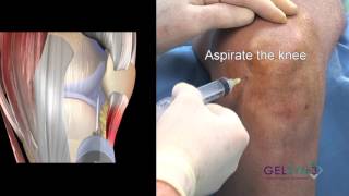 Inferior Medial Flexed Knee GELSYN3 [upl. by Jacoba505]