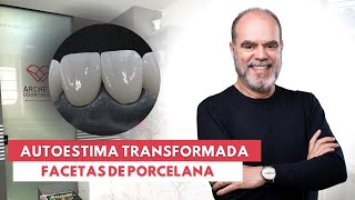 Facetas de Porcelana Autoestima Transformada [upl. by Zimmermann572]