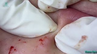 Big Cystic Acne Blackheads Extraction Blackheads amp Milia Whiteheads Removal Pimple Popping 020 [upl. by Ahtamas605]