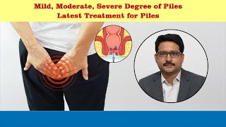 Treatment options for piles  Dr Sujay B R  Nano hospitals bengaluru [upl. by Celene]