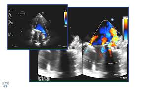 ASE 2021 Prosthetic Mitral Valve [upl. by Rand]