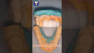 Ceramic Teeth  Upper Anterior  Maxillary Insicor  PFM  Tamil Dental Lab  tamildentist shorts🦷 [upl. by Modnarb]