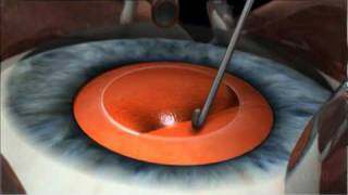 Phacoemulsification Cataract Surgery [upl. by Fishbein]