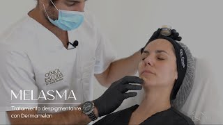 Tratamiento de melasma con Dermamelan [upl. by Thibault]