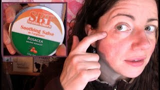 Skin Reaction Disaster How I Recovered My Rosacea Prone Face not sponsored  Rosy JulieBC [upl. by Alyose166]