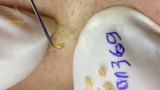 Loan Nguyen Acne Treatment 368pre [upl. by Asiat]