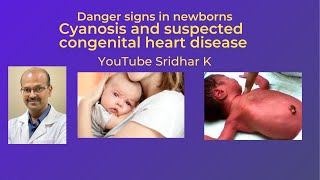 Cyanosis in a baby Suspected congenital heart disease Dr Sridhar K [upl. by Timmi955]