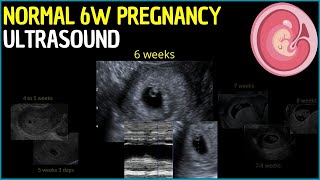 Early Glimpse 6Week Pregnancy Ultrasound Revealed [upl. by Jed7]