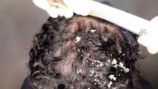 Dandruff Scratching My Husband Has Big Flakes  NO TALKING Pt 12 Flare Up Hair Cleaning [upl. by Kathrine]