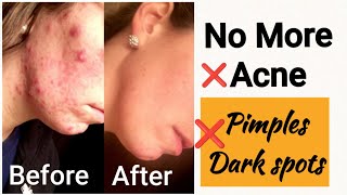 No More Acne Pimples Dark spots  How to treat acne at home with neem  Get clear skin [upl. by Notsirt]