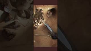 Kidney Stone Surgery Using Laser [upl. by Molli29]