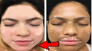 Successful Treatment of Vitiligo With 01 Tacrolimus Ointment [upl. by Leahcimed]