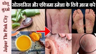 khujli ki dawa  खुजली सोराइसिस एक्जिमा दाद के घरेलू नुस्खे How To Cure Psoriasis and Eczema [upl. by Wanfried492]