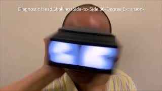 Head Shaking Nystagmus [upl. by Sculley]