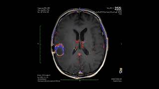 Imaging Biometrics quotIBquot and FTBexpress  a quotfractional tumor burdenquot workflow [upl. by Agnew]