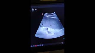 Ultrasound  Spleenomegaly  Splenic Varices  Chronic liver disease  Portal hypertension  CLD [upl. by Aix]