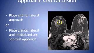 MRI Breast Biopsy Section C Tips amp Tricks on Preparation for radiologists [upl. by Htebharas]