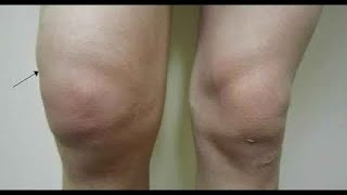 كيف نتخلص من ماء الركبة وإنصبابهاKnee joint effusion الدكتور عقبة نافع الناصري Uqba N Yousif [upl. by Dodwell]