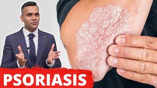 Psoriasis Treatment  The Best 2 Remedies For Psoriasis [upl. by Fowkes]