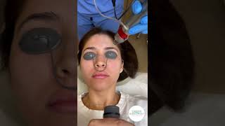 Erbium Laser easy and fast treatment [upl. by Enneirda]