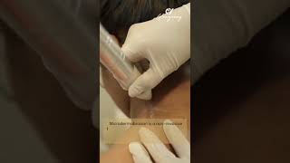 𝐃𝐚𝐫𝐤 𝐍𝐞𝐜𝐤  microdermabrasion Treatment  Neck pigmentation darknecktreatment darkneck [upl. by Cornel]