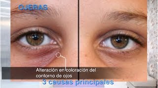 ojeras causas eliminar tratamiento [upl. by Koral858]