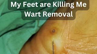 Wart removal  My feet are killing me  HealthAll12 [upl. by Rahsab]