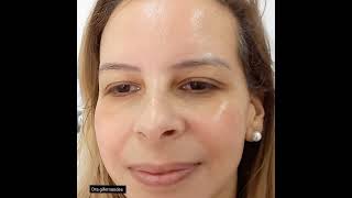 Tratamento para Melasma dragifernandes [upl. by Zampardi]